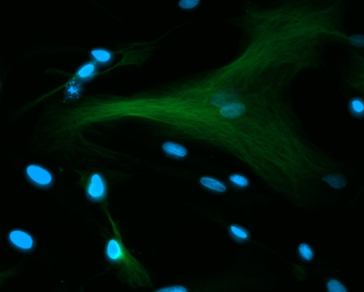 VEGF Suppression and EBC-46: How Tigilanol Tiglate Affects Tumour Angiogenesis